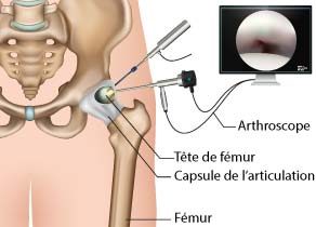 arthroscopie-deroulement-examen