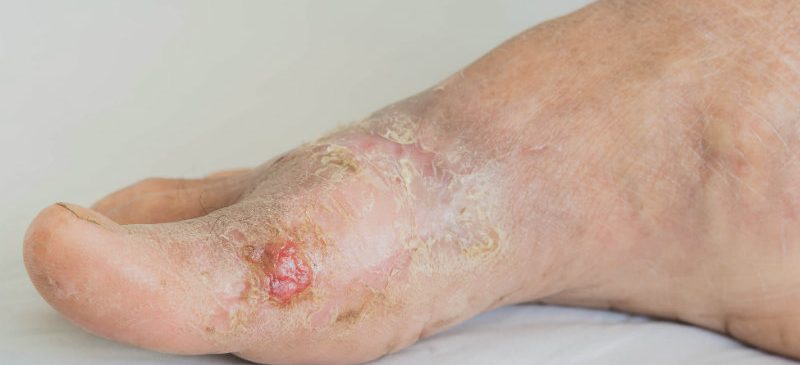 Infections cutanées sur un pied