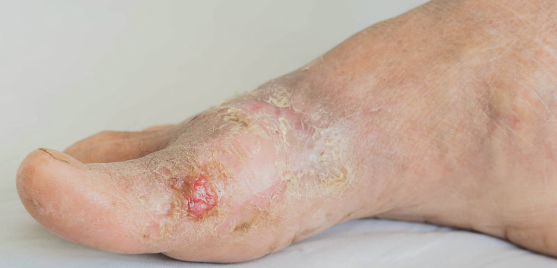 Infections cutanées sur un pied