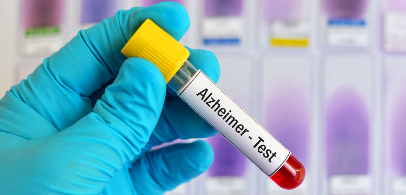 inflammation-Alzheimer