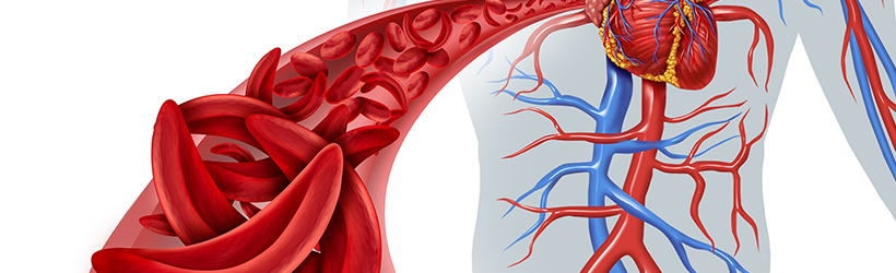 Blocage circulation sanguine par des cellules faucille dû à des cardiopathies congénitales