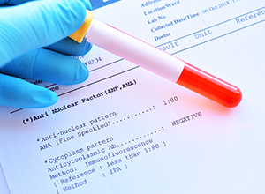 Résultat de laboratoire de test de facteur antinucléaire pour détecter la dermatomyosite