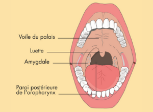 angine-pulcatee