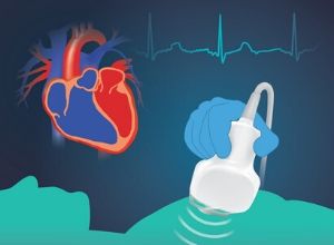 deroulement-examen-echocardiographie