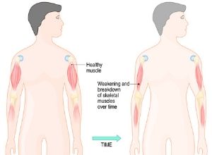 Schèma musculaire des muscles victimes de dystrophie