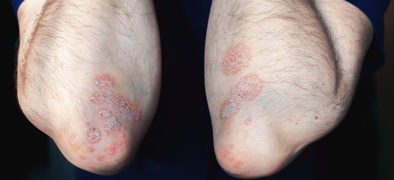 Coude d'un homme, marqués de lésions liées au psoriasis