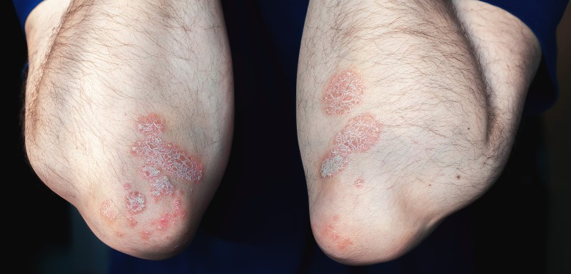 Coude d'un homme, marqués de lésions liées au psoriasis