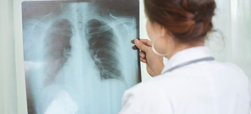 Médecin femme qui analyse une radiographie des poumons