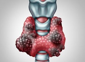 ganglions du larynx