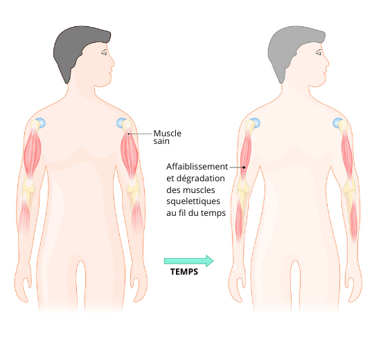 schéma décrivant comment se présente la myopathie de dychenne