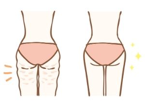 Illustration montrant une femme de dos avec de la cellulite et une autre à côté sans cellulite