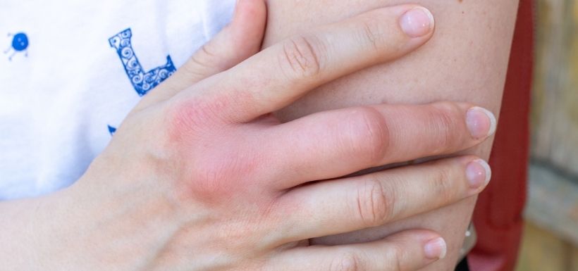 La main d'une personne est enflée à cause d'une piqûre de moustique.