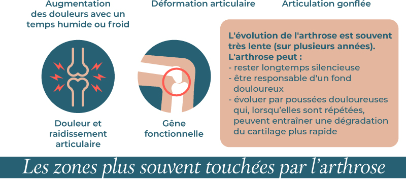 Infographie : L'arthrose en France