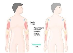 Schéma de l'atrophie musculaire