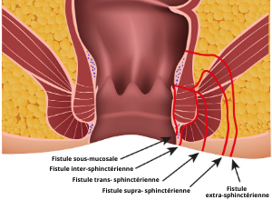 schéma d'une fistule