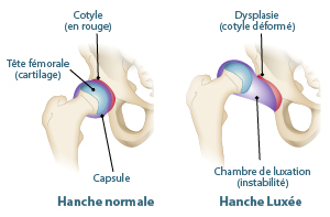 schéma luxation hanche 