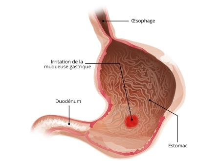 schéma pour représenter une gastrite