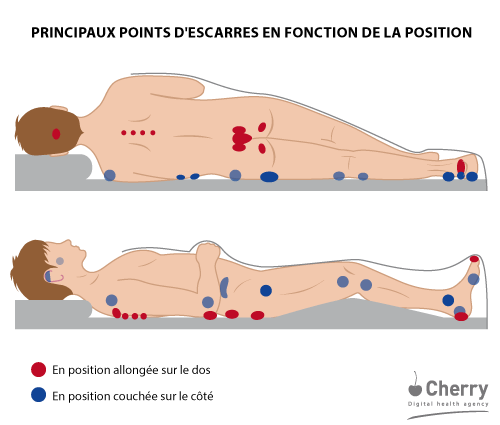 Points d'escarre - schéma