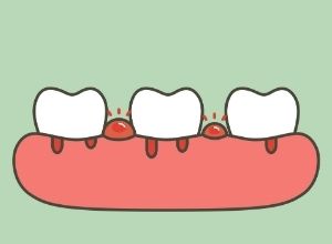 schéma de dents douloureuses