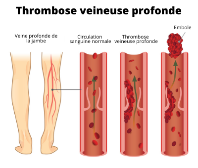 Schéma Thrombophilie