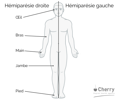 Schéma pour montrer une hémiparésie