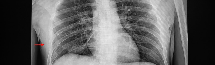 Radiographie pour voir un pneumothorax