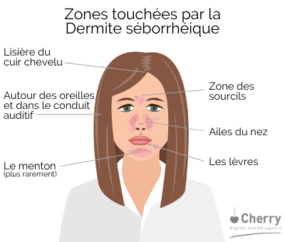 Zones touchées par la Dermite séborrhéique