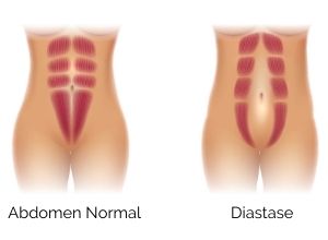 définition de la diastase abdominale