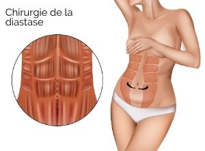 traitement de la diastase abdominale