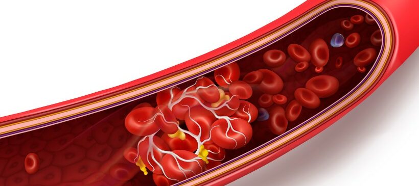 Thrombose et vaccin Covid-19