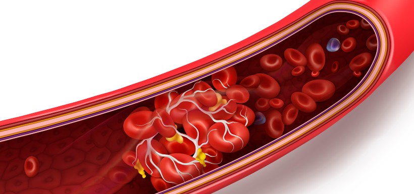 Thrombose et vaccin Covid-19