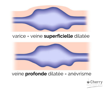 schéma sur les différents types de varices