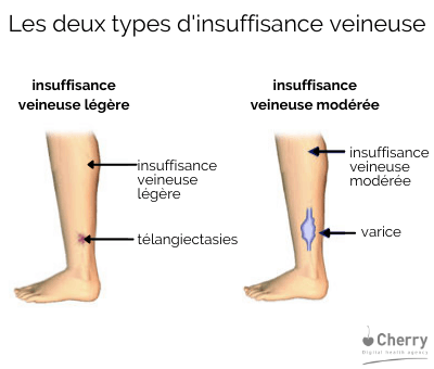 types d'insuffisance veineuse