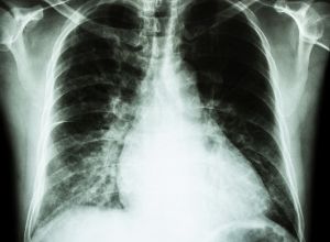 radiographie pour identifier une Cardiomégalie 