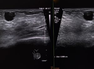 Radiographie d'un Kyste du sein 