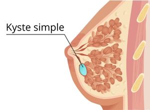 Schéma d'un Kyste du sein 
