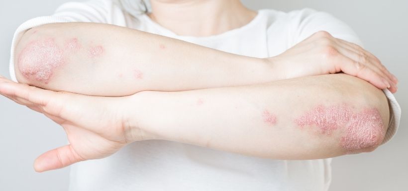 Psoriasis : Vers une stratégie thérapeutique