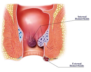 Hemorroides internes et externes