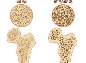 Osteoporose