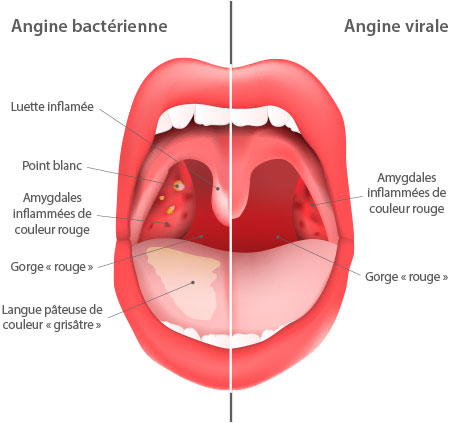 angine bactérienne ou angine virale