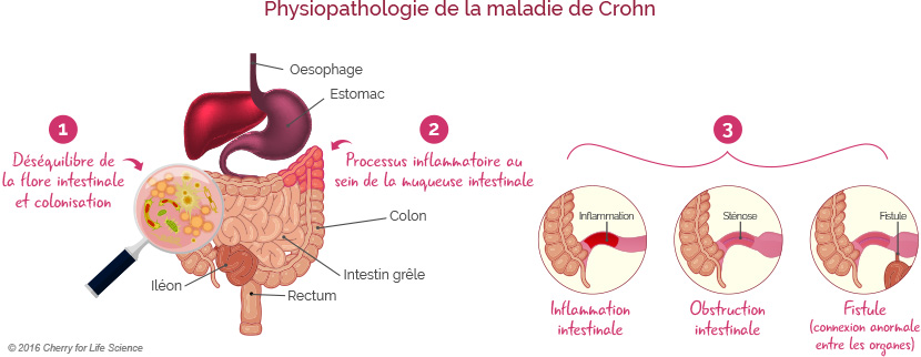 Schéma maladie de Crohn