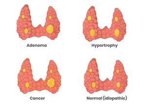 l'hyperparathyroïdie