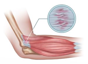 Schéma d'un coude pour montrer une épicondylite