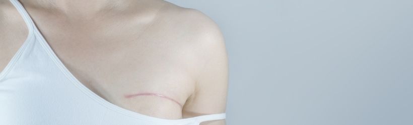 femme avec une reconstruction mammaire