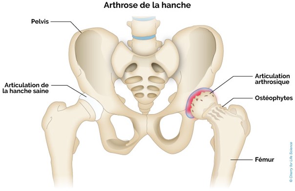 dessin explicatif de l'arthrose de la hanche 