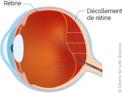 causes du décollement de rétine 