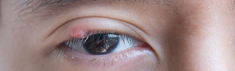 Chalazion