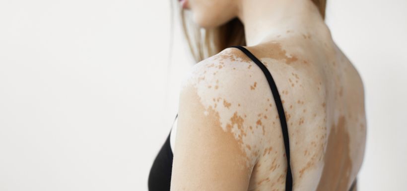 Une femme atteinte de vitiligo montre son dos.