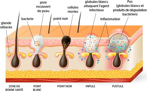 schéma explicatif de l'acné