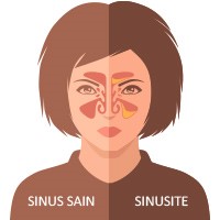 sinusite